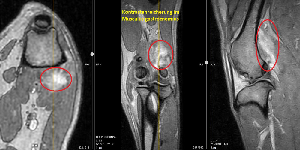 Kernspintomografiebilder des Wadenmuskels